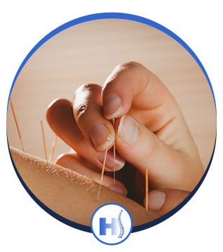 Acupuncture in Jersey City, NJ