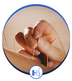 Acupuncture in Jersey City, NJ